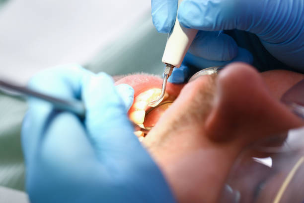 Best Emergency Tooth Extraction in Hanscom Af, MA
